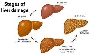 آشنایی با سیروز کبدی، راههای پیشگیری و درمان آن